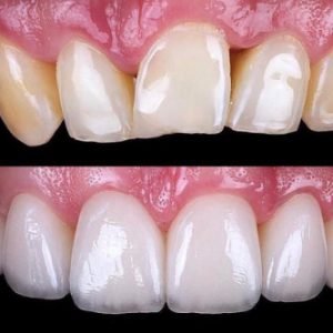 dental-veneers-NYC-before-after (1) dental-veneers-NYC-before-after (1)